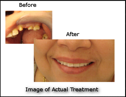 Example of a dental Bridge